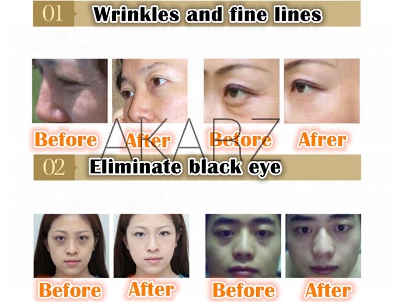 AKARZ Eye Care Serum - Reduce Wrinkles & Dark Circles, Relieve Tired Eyes - 10ml Essence Eye Care Serum